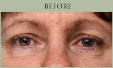 Before picture when using CosMedix Opti Crystal Eye Cream