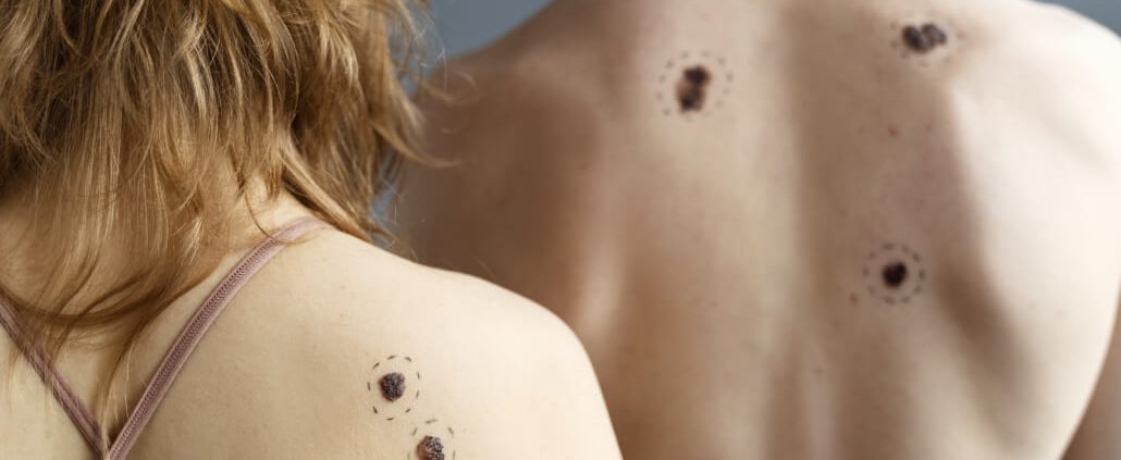 two people with signs of melanoma in moles on their backs